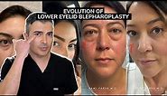 Evolution of Lower Eyelid Blepharoplasty | Dr. Parsa Explains Trifecta Lift