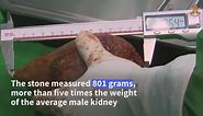 Sri Lankan doctors remove world's largest kidney stone | AFP