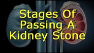 Stages of Passing A Kidney Stone