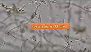 Urine under the Microscope showing hyphae indicates Fungal UTI