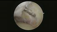 Minimally Invasive Ankle Surgery: Arthroscopic Resection of Anterior Impingement Bone Spurs