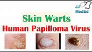 Overview of Skin Warts (Verrucae) | What Causes Them? Who Gets Them? | Subtypes and Treatment