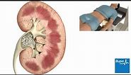 How extracorporeal shockwave lithotripsy is used to treat kidney stones