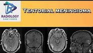 Tentorial meningioma