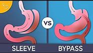 Gastric Sleeve vs Bypass Surgery: What's The Difference?