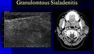 Ultrasound Imaging of the Salivary Glands