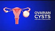 Ovarian Cysts - Symptoms and Complications Explained by an OB-GYN