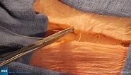 Sutures and Knot Tying: Buried Subcutaneous Knot Suture