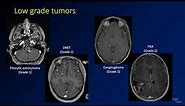 Imaging brain tumors - 4 - Other low grade gliomas