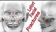Lefort 1-3 Upper Jaw (Mid-Face) Facial Fractures