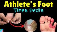 Athlete's Foot (Tinea pedis): Symptoms, Causes & Treatment - Foot Fungus