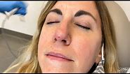 Removing a Small Bump on the Nose (Fibrous Papule)