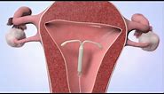 Patient Education Video: Intrauterine Device (IUD)