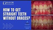 How to Get Straight Teeth Without Braces - Gluck Orthodontics