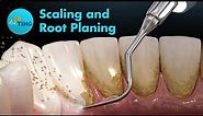Scaling and Root Planing (SRP) | Ask Dr. Ting