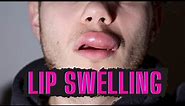 CAUSES OF SWOLLEN LIPS AND HOW TO TREAT