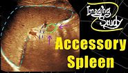 Accessory Spleen || Splenunculus || Ultrasound || Case 114