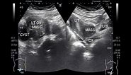 Anterior wall Uterine Fibroids, Ovarian Mass and, Hemorrhagic Ovarian Cyst.