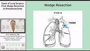 Types of Lung Surgery: From Wedge Resection to Pneumonectomy