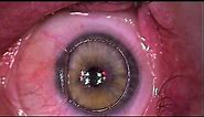 LASIK and Raindrop Near Vision Inlay Performed in Same Eye
