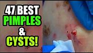 47 Big Blackheads, Cysts, Pimples and Whitehead Pops! Acne, Zits & Popping