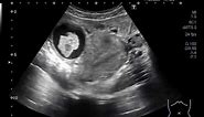 Ultrasound Video showing Ovarian Cystic Mass.
