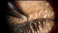 Eyelid Skin Tag Removal Viral Papilloma