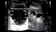 A trabeculated urinary bladder with bilateral renal dilated pelvicalyceal System.