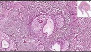 Brenner Tumor - Ovary, Histopathology