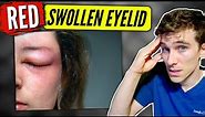 Swollen Eyelid: (causes & solutions) - Eye Doctor Explains