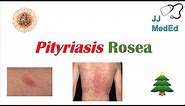 Introduction to Pityriasis Rosea | Possible Causes, Symptoms and Treatment