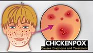 Chickenpox, Causes, Signs and Symptoms, Diagnosis and Treatment.