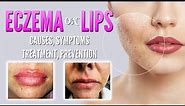 Eczema on lips causes, symptoms, treatment, remedies, prevention | Lip dermatitis, Lip Cheilitis