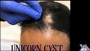 Unicorn Cyst (scalp cyst incision and drainage)