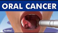 ORAL CANCER and tumors in the mouth, lips and tongue ©