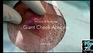 Large cheek abscess. Inflamed cyst pop and drainage. I+D. Dermatology procedure. MrPopZit