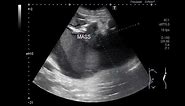 Ultrasound Video showing a large Renal Mass.