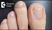 What causes white spots on toenails? - Dr. Aruna Prasad