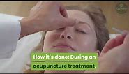 Acupuncture for Psoriasis: How Is It Done and Is It Effective?