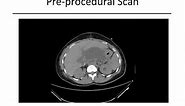 Image-Guided Percutaneous Drainage of Abdominal Abscessed and Fluid Collections