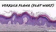 Verruca Plana (Flat Wart under the microscope): 5-Minute Pathology Pearls