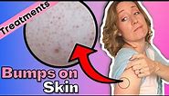 Red Bump on Your Arms | How to Treat Your Keratosis Pilaris at Home.