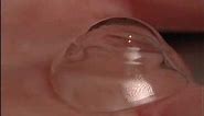 Scleral Contact Lenses-Mayo Clinic