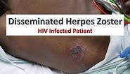 Disseminated Herpes Zoster Infection in an HIV Patient