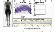 Bone Density Scanning and Results Score Analysis
