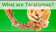 What are Teratomas? - Pathology mini tutorial