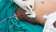 Chest drain tube/ intercostal tube thoracostomy procedure