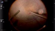 Induction of Macular Detachment for Persistent Full-Thickness Macular Hole - Eyetube