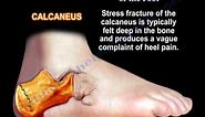 Stress Fractures Of The Foot - Everything You Need To Know - Dr. Nabil Ebraheim