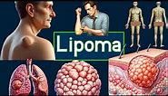 Lipoma Explained - Lump under the skin